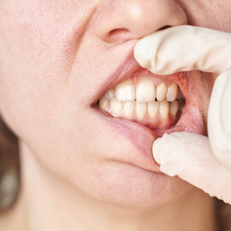 Female Caucasian adult dental examination with gloved hands close up teeth.